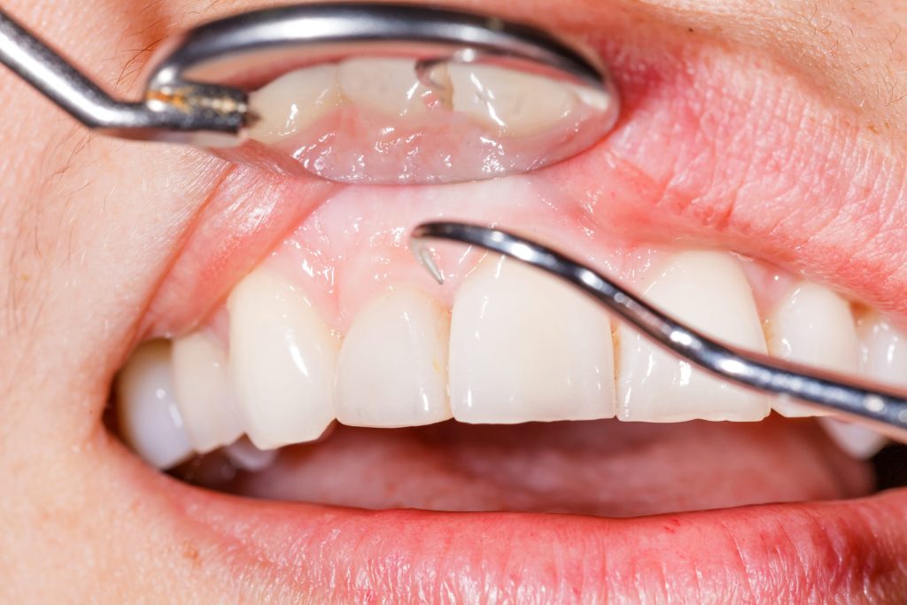 Come prevenire la parodontite: guida completa per una salute orale duratura 1 Come prevenire la parodontite