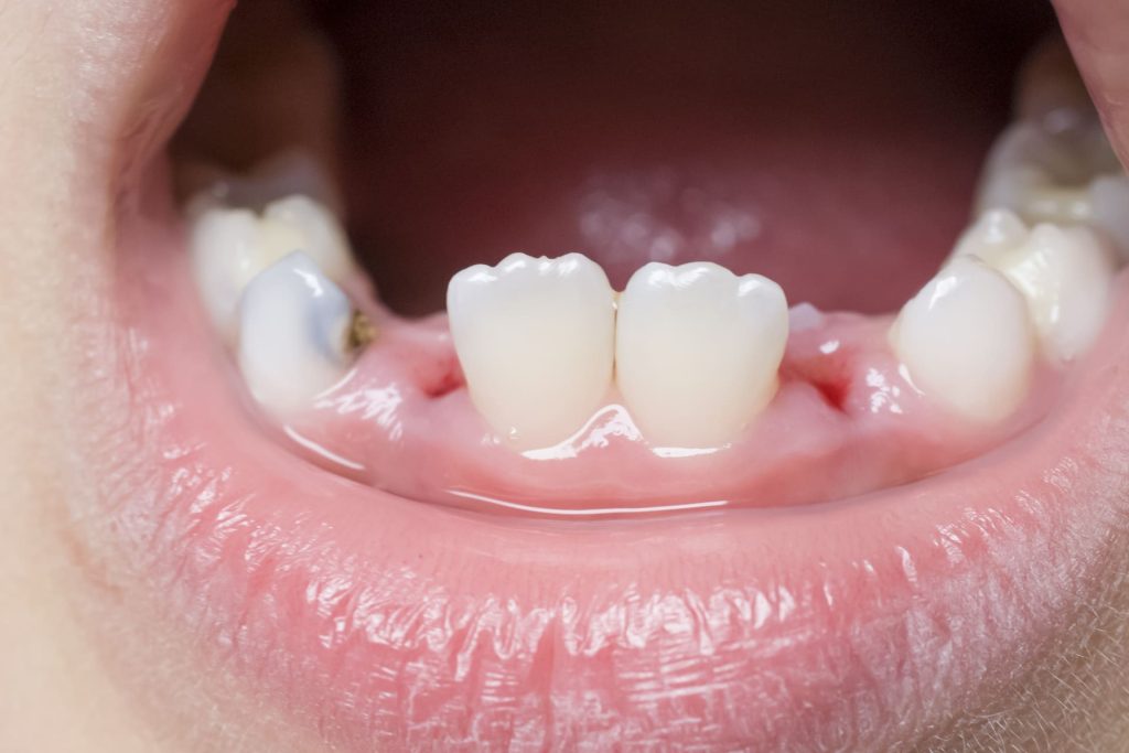 Quando iniziano a spuntare i dentini: Guida Completa per i Genitori 1 Quando iniziano a spuntare i dentini