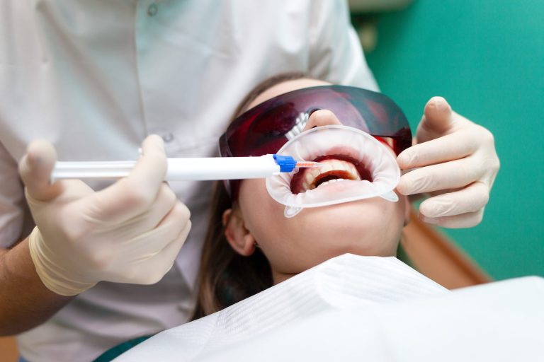 Come funziona lo sbiancamento dentale dal dentista