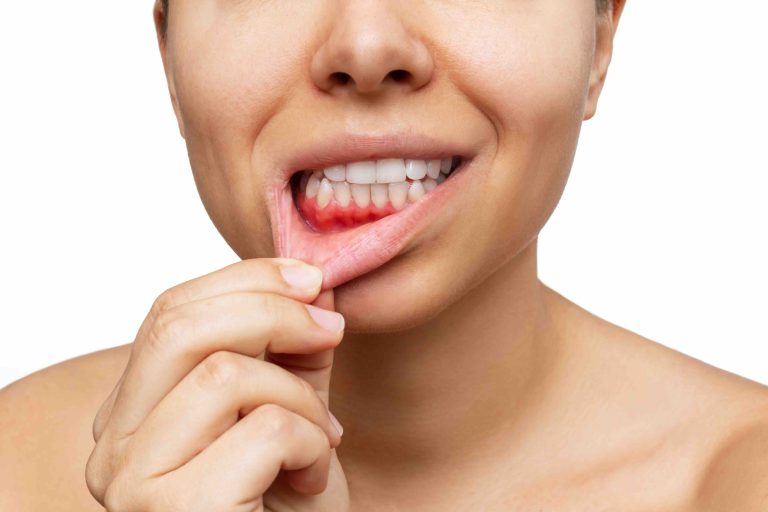 Blog 1 Miglior dentifricio per la parodontite